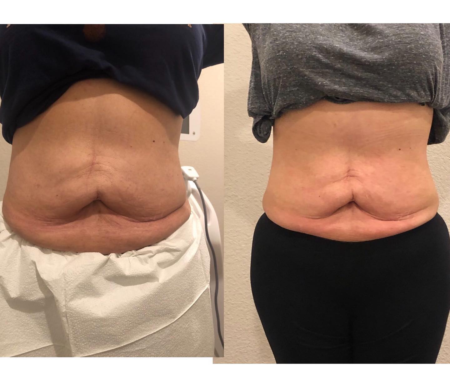 Body-sculpting georgetown tx