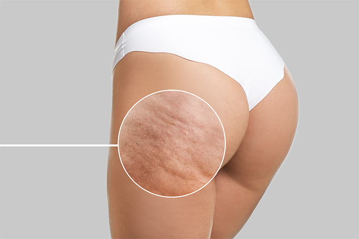 Cellulite Reduction Georgetown, TX